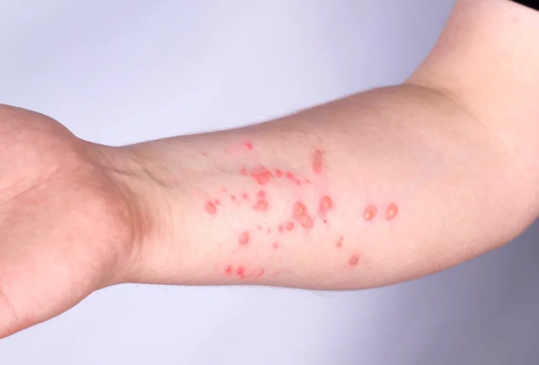 Nova variante da mpox preocupa e levanta dúvidas sobre antiviral